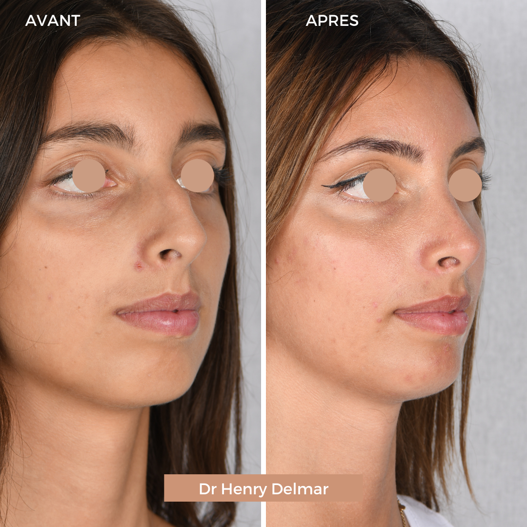 Profiloplasty: What is Profile Aesthetics?