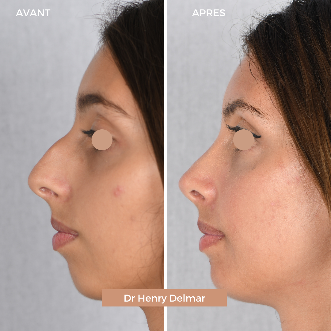 Profiloplasty: What is Profile Aesthetics?